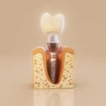 How to Prevent Dental Implant Side Effects: Tips for a Smooth Recovery