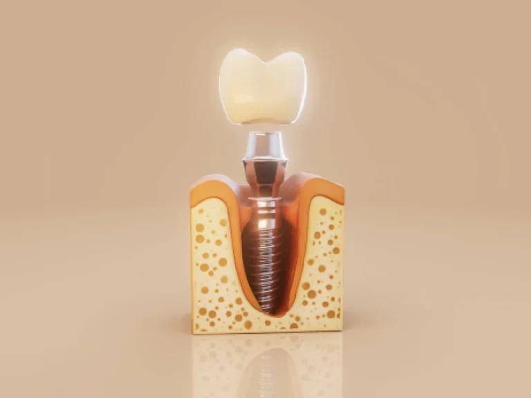 How to Prevent Dental Implant Side Effects: Tips for a Smooth Recovery