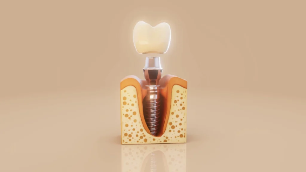 How to Prevent Dental Implant Side Effects: Tips for a Smooth Recovery